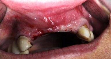 Modyfikowanie dziąsła w strefie estetycznej łącznikami standardowymi i Encode – porównanie metod leczenia