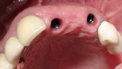 Screw-retained, implant-supported fix partial denture (FPD)