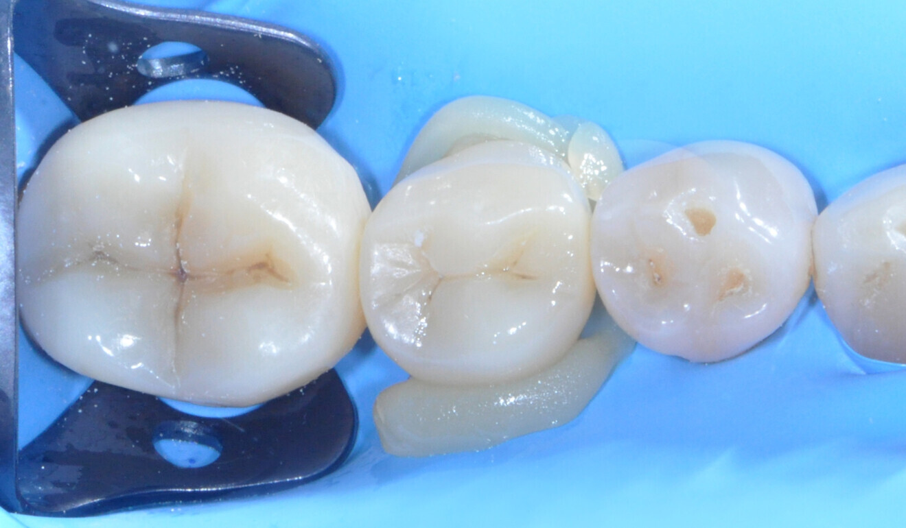    Fig. 22: Restoration placed under dental dam isolation. 