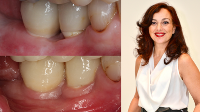 Δεν εμφανίζεται περιεμφυτευματίτιδα γύρω από ένα σύστημα εμφυτευμάτων δύο μερών: Περισσότερα μακροπρόθεσμα στοιχεία