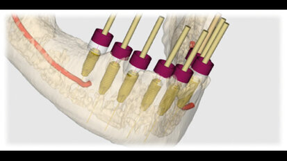 Planificación y Tratamiento mediante Cirugía Guiada Asistida por Ordenador