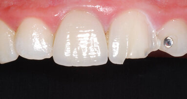 Ripristino estetico con tecnica press on paint nella pratica quotidiana