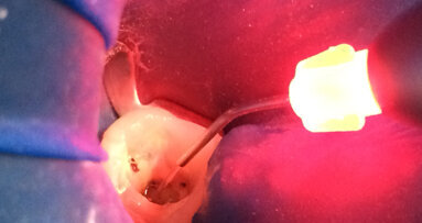 El efecto antibacteriano del láser en endodoncia