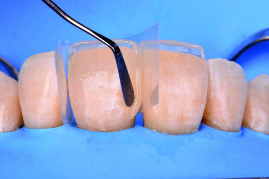 Fig 11. Diastema closure with Beautifil II LS shade A2 and Beautifil II Enamel shade HVT