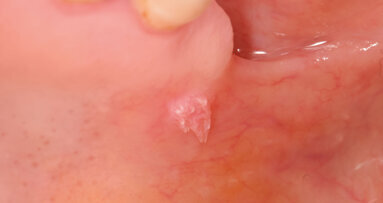 Effetti della Zn-L-Carnosina sulle lesioni della mucosa orale: case report