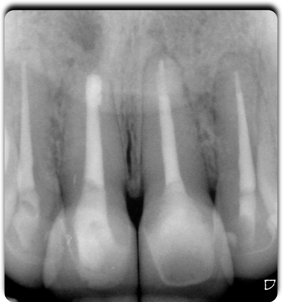 Fig. 14-16 - Il caso ultimato.