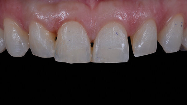 Fig. 7. Tejido periodontal de los dientes anteriores seis meses después del alargamiento coronario.