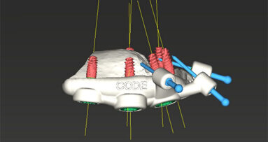 Celková rekonstrukce chrupu pomocí implantátů Straumann BLX a Pro Arch navigované chirurgie