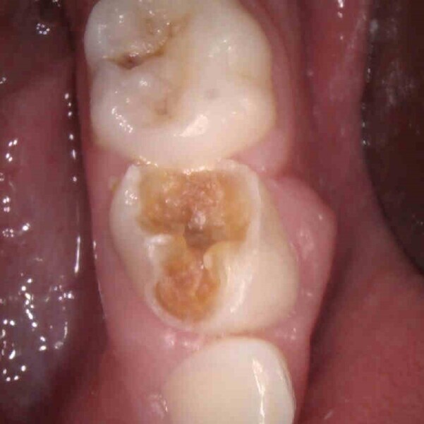 Fig. 5 : Situation initiale. Lésion carieuse avancée et abcès en vestibulaire.