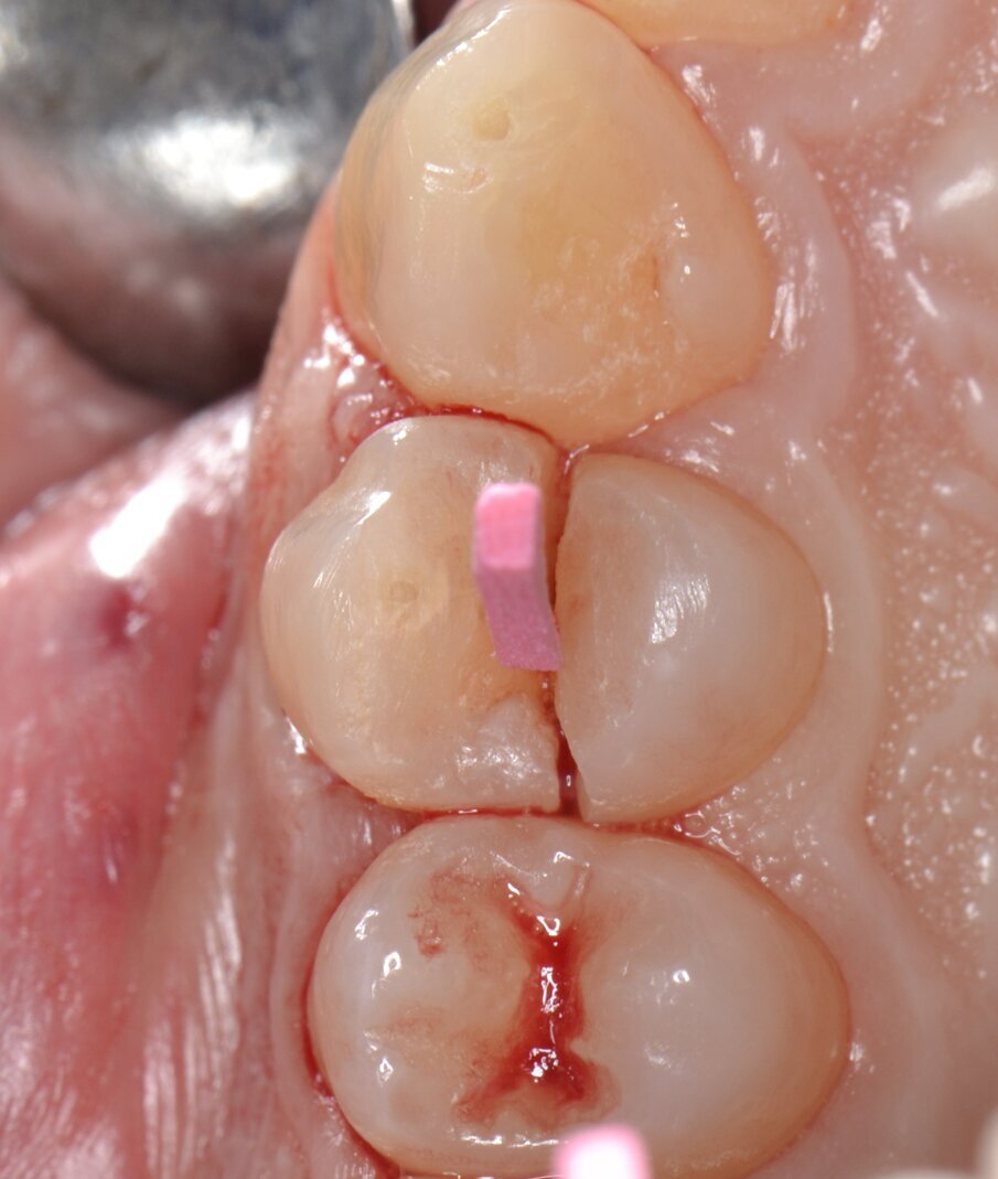 Fig. 1 - Elemento 1.4 fratturato (visione occlusale).