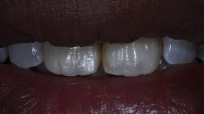 Bringing anterior direct restorations to life using surface textures