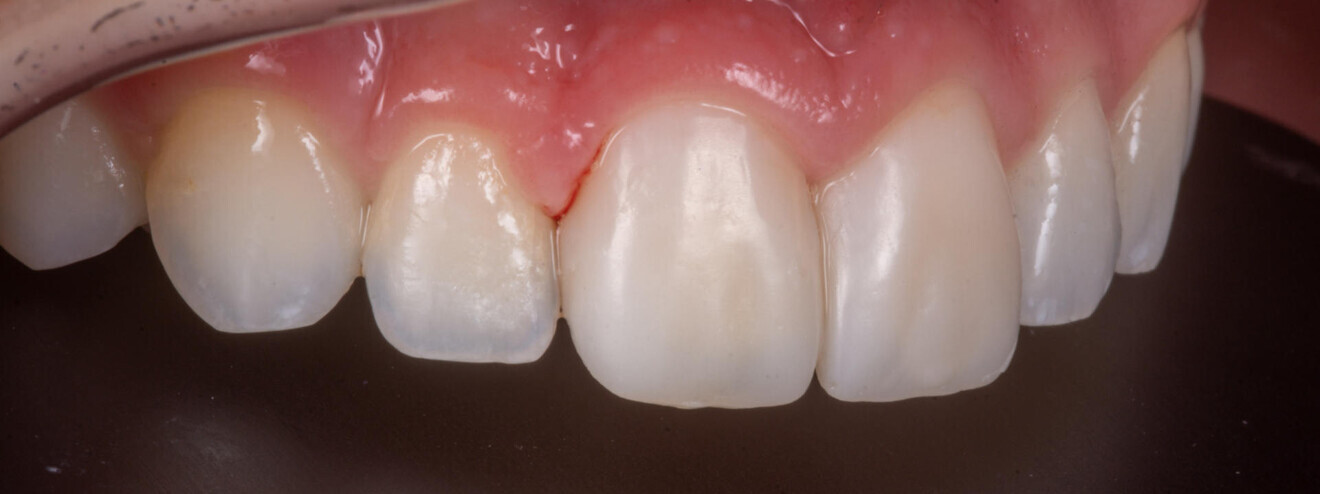 Fig. 24 : Facettes mono-teintes sur 11 et 21.