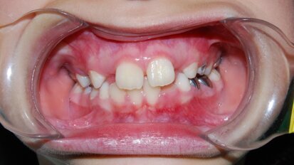 Abordaje odontológico del Síndrome de Prader-Willi: Desafíos y consideraciones clínicas