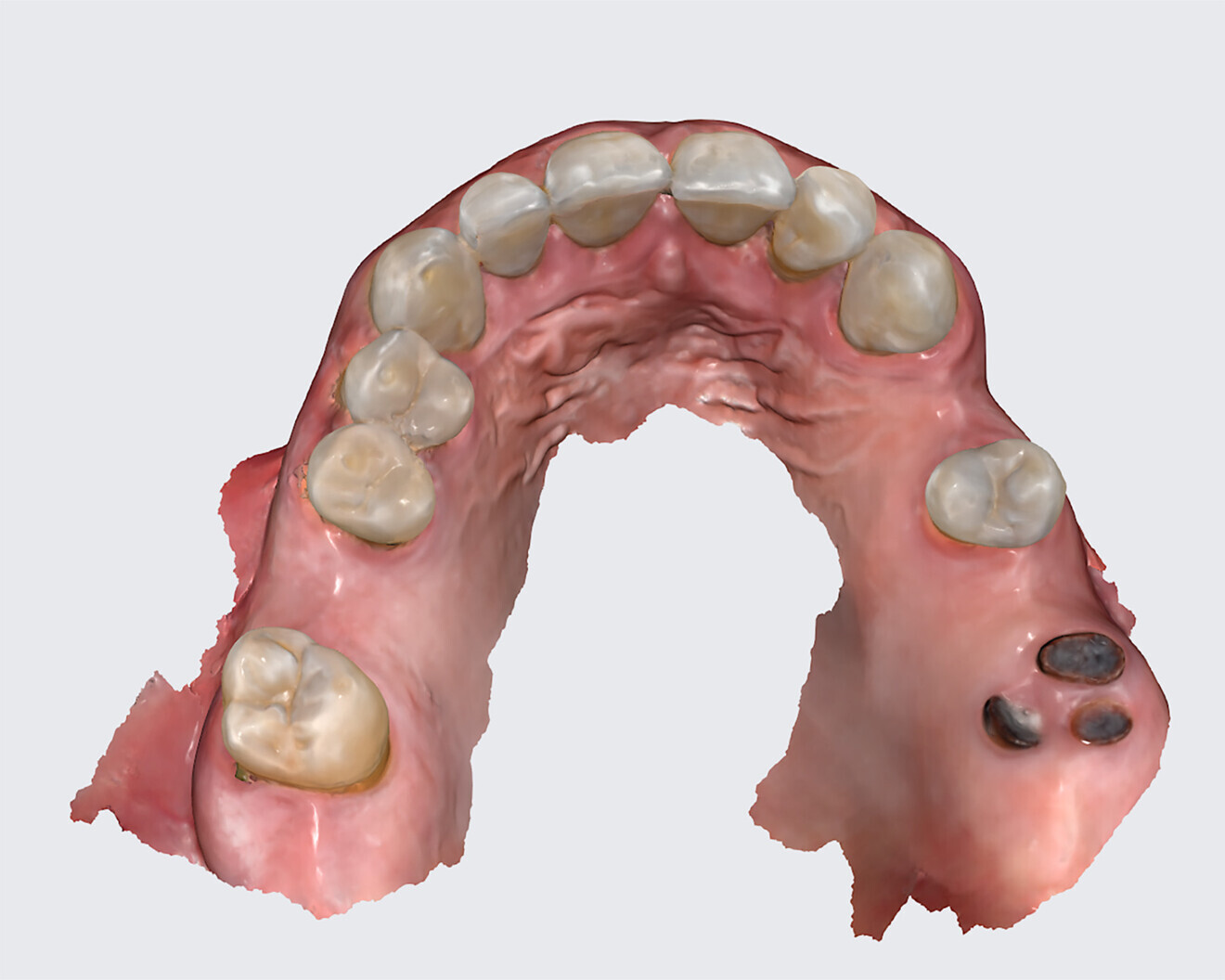 Fig. 11c: Mandibular intra-oral scan.