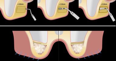 Piezocirugía  (9). Ventajas del piezoeléctrico en la terapia sinusal