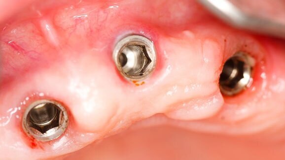 FDA обмисля ново класифициране на денталните имплантати