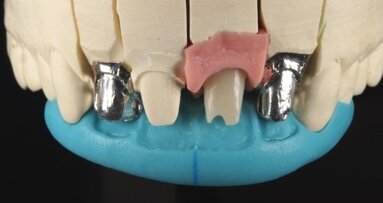 Złożona technika ceramiki i łącznik hybrydowy Ti/Zr w rozwiązaniu trudnego przypadku estetycznego