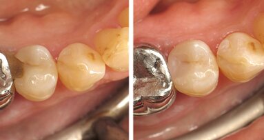 Restauración clase II con composite termoviscoso