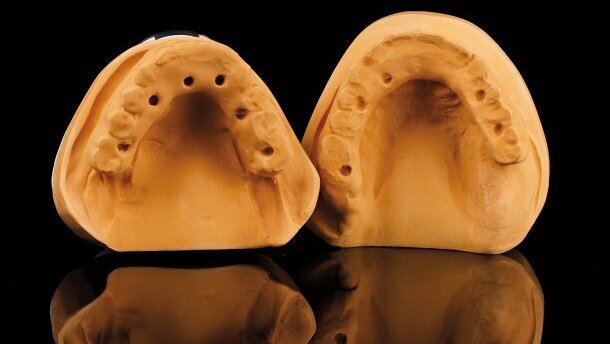 Réhabilitation occlusale transvissée maxillaire et mandibulaire sur bases en titane