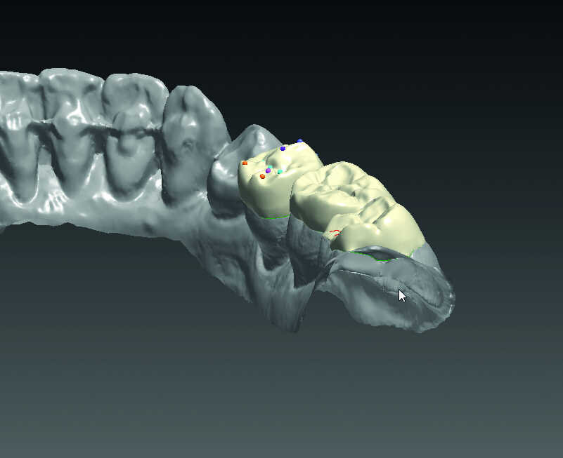 Fig. 6 : Wax-up virtuel et contrôle de l’occlusion.