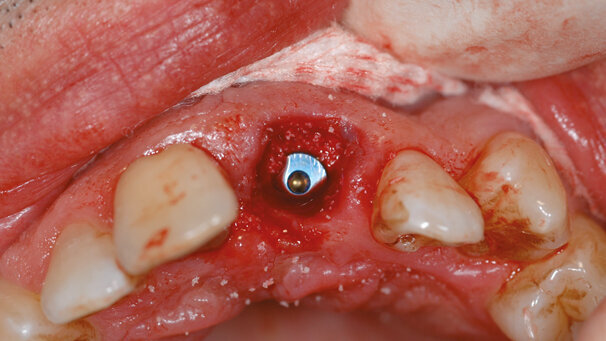 Nuove soluzioni implanto-protesiche nell’impianto post-estrattivo immediato