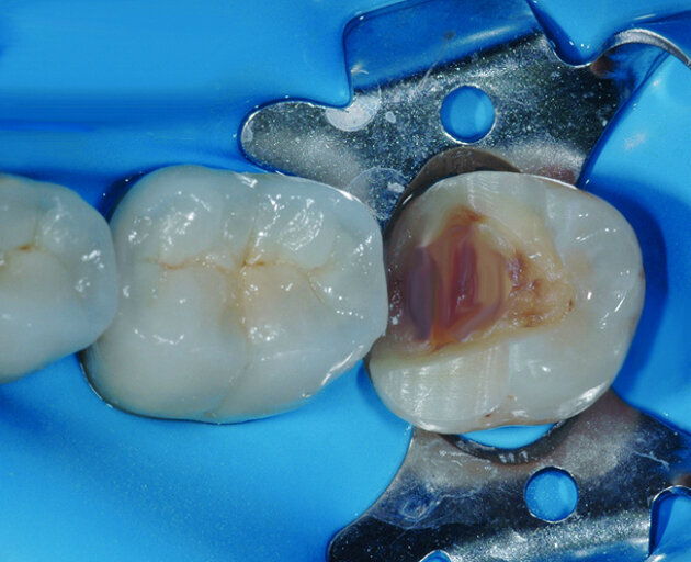 Fig.3 : Vue occlusale
après dépose de l’ancienne restauration, curetage du tissu carieux et mise en forme de la cavité pour recevoir un onlay composite. 

