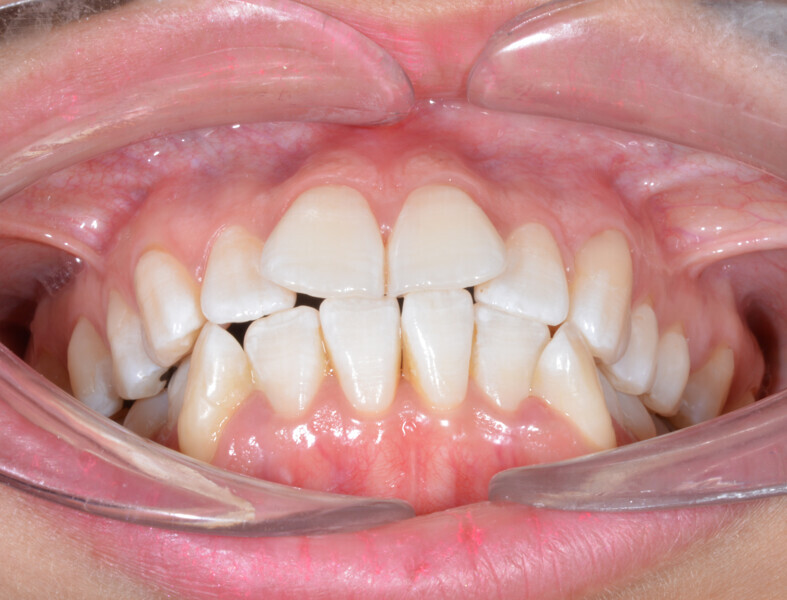 Fig. 3b: Initial occlusal photograph.