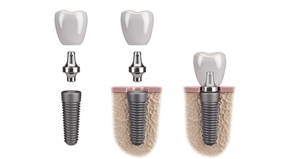 Zahnersatz als Allergieauslöser