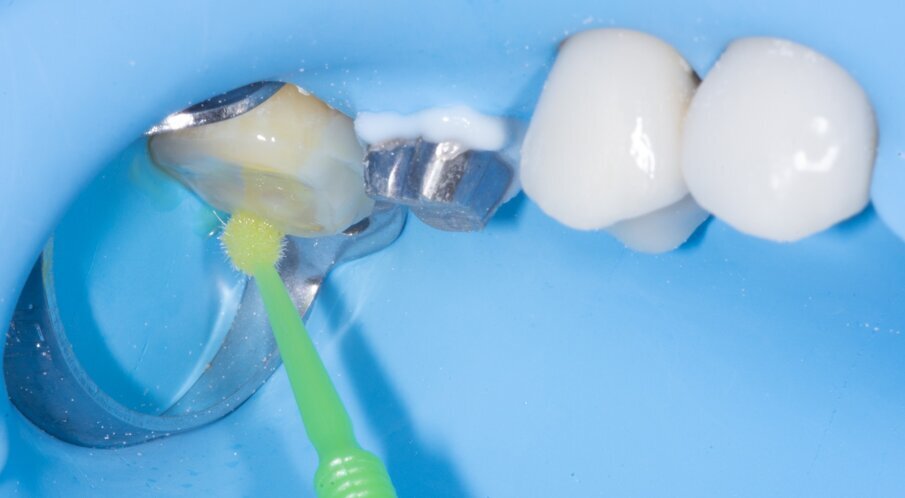 Fig. 11: Application of G2-BOND Universal 1-PRIMER.