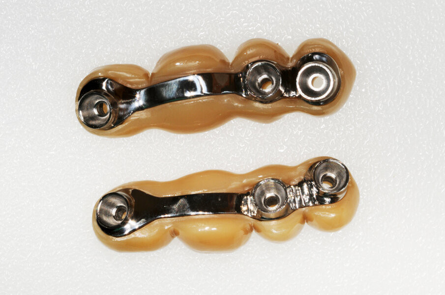 Obr. 13–18: Konstrukce Atlantis BridgeBase, zirkonové můstky a finální náhrady.