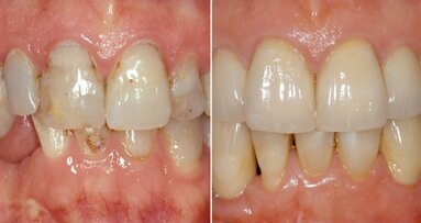 Уебинар се фокусира върху имплантологията, съчетана с дигиталните технологии