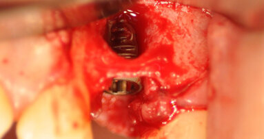 Posizionamento immediato di un impianto Neoss ProActive Edge in osso compromesso