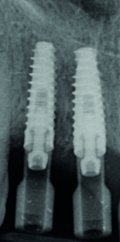 Fig. 12 : Radiographie de contrôle objectivant le bon enfoncement des scan bodies.