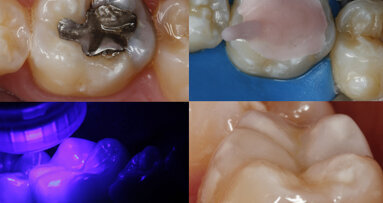 Restauración con resina compuesta usando una matriz oclusal