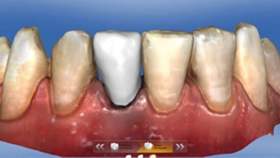 Fig. 8. La corona monolítica diseñada se confeccionó a partir de la cerámica vítrea reforzada con dióxido de circonio VITA SUPRINITY PC T 0M1.