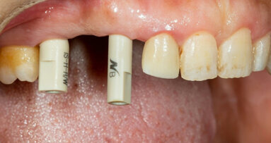 Digital implant restorations