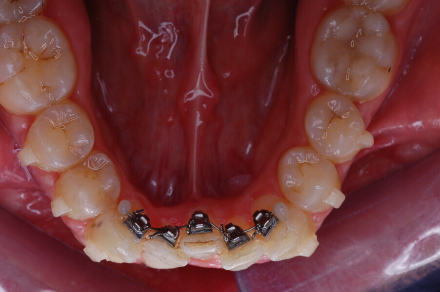 Fig. 32: Sectional lingual appliance in place.