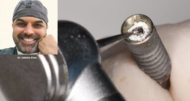 Broken screw removal hack - Dr. Udatta Kher