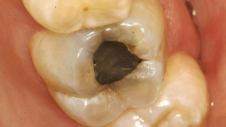 Caso clínico. Preparaciones cavitarias en lesiones restauradas con cemento  de ionómero de vidrio de alta viscosidad reforzado (Tercera parte)
