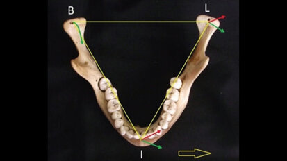 Condylar retrusion on the horizontal plane associated with retrusive lateral excursion