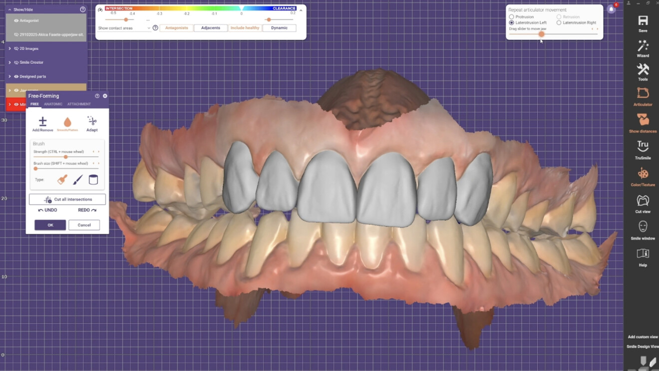 Fig. 2b: Digital design of the six maxillary anterior veneers and evaluation of tooth form, tooth proportions and occlusal relationships.