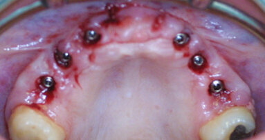 Quick and easy prosthetic planning
