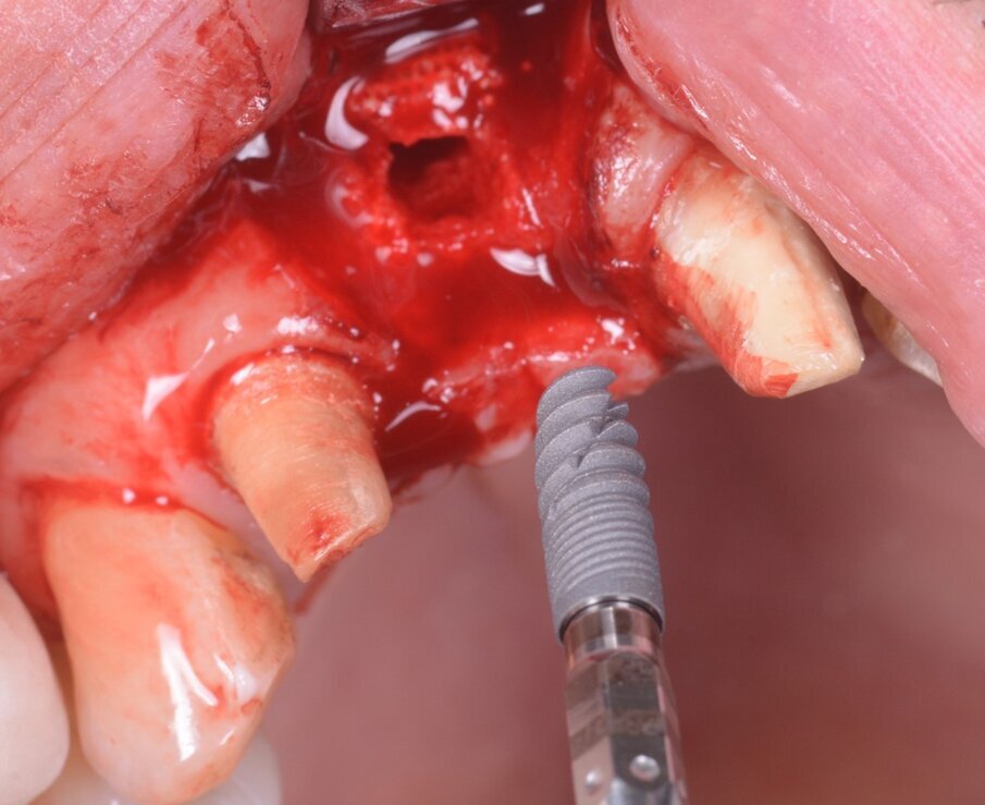 Fig. 18_L’impianto (Naturactis, Lyra ETK) è pronto per essere inserito manualmente (e non attraverso la dima, in questo caso).