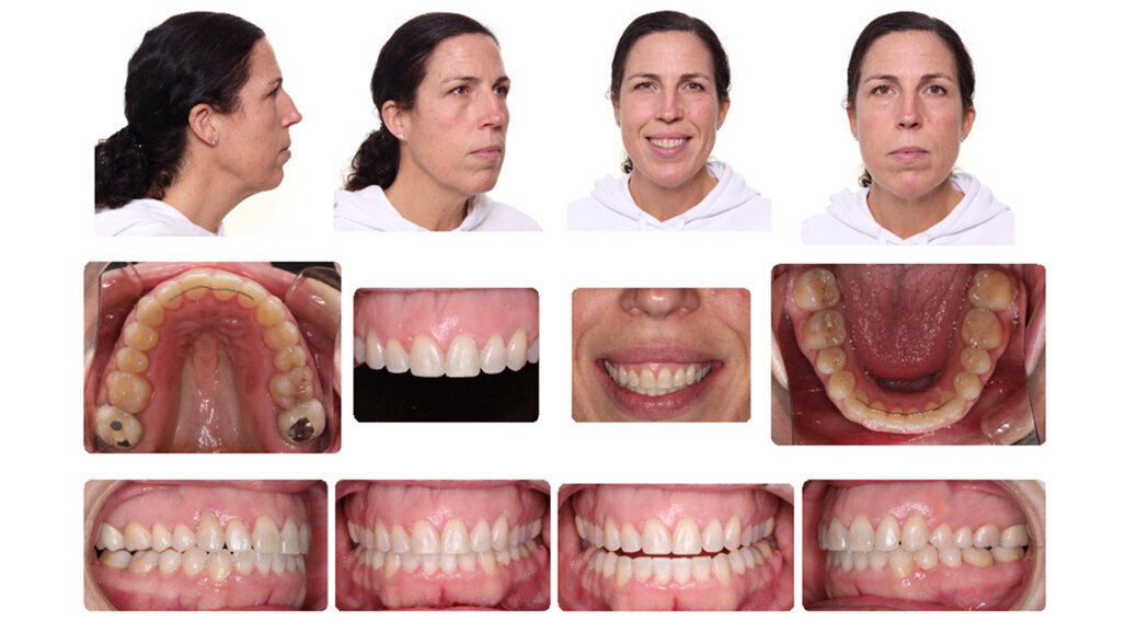 Case study: Class I crowded malocclusion with moderate maxillary and mandibular crowding