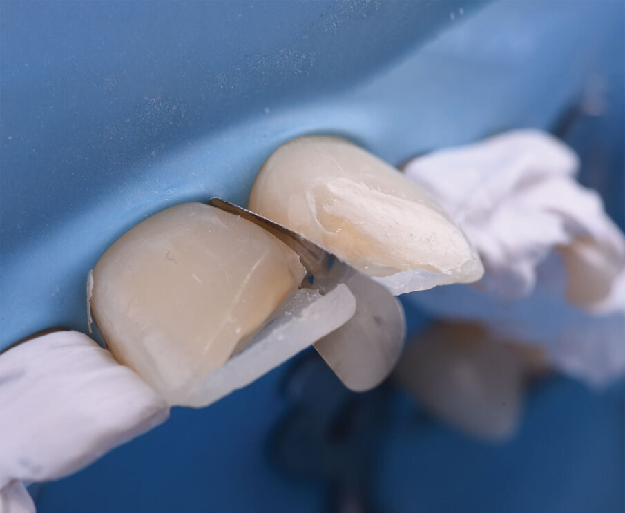 Sl. 10b: Modelovanje aproksimalnog zida restauracije