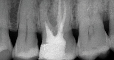 Micro-endodonzia chirurgica: lo stato dell’arte