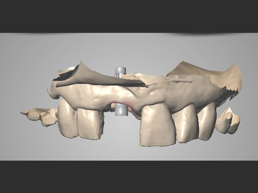 Figg. 8a, 8b - Acquisizione intraorale: visione frontale.