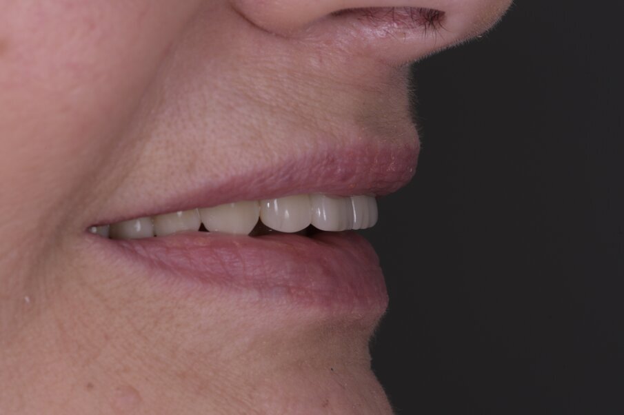 Fig. 48_Eseguendo fotografie laterali dx e sx riusciamo a vedere la naturale posizione del labbro superiore a riposo e nel sorriso, confrontandole (Fig. 3) riscontriamo il successo nella rimozione della flangia in resina con una rigenerazione ossea e con la forma coronale, rimuovendo il codice a barra presente in Figura 4.