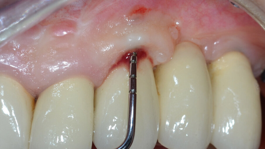 Fig. 1 - Sondaggio peri-implantare.