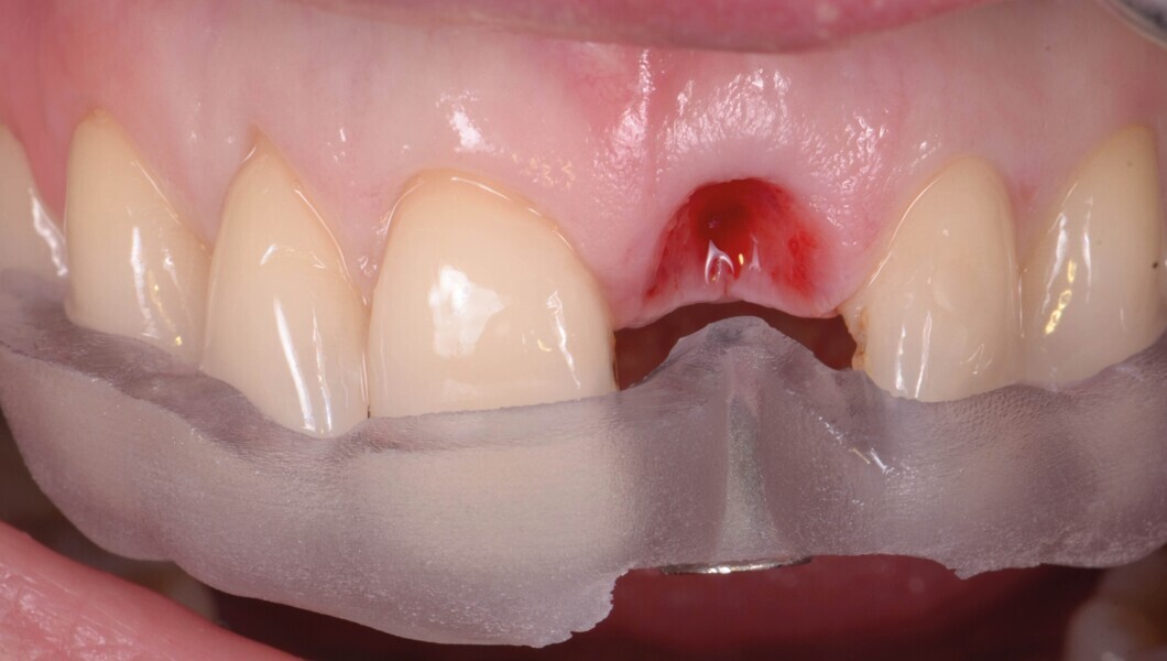Fig. 11a : Position de forage optimisée du premier foret. La partie interne contient un manchon de forage en titane, pour assurer la précision de l’angulation et du niveau de butée (b). 